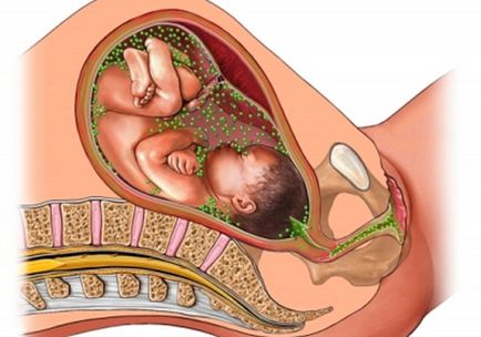 Chlamydia női és férfi tünetei, diagnózisa, kezelések, oslozhenenija chlamydia