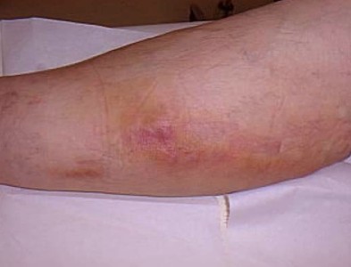 Az érbetegség az alsó végtagok láb tünetek és a kezelés, mit kell tenni, amikor a fájdalom