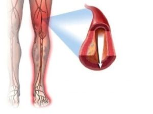 Betegség az alsó végtagok tünetek és érbetegségek kezelésében a lábak