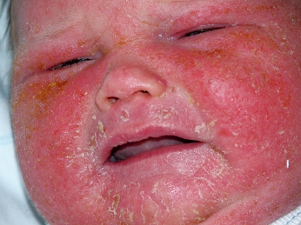 Staphylococcus aureus gyermekeknél a tünetek, mértékét, hatásait S. aureus