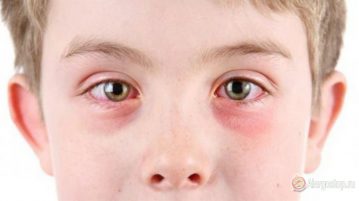 Allergia viszkető szemek és a könnyező, duzzadt - mint ödéma, a szemhéj a gyermekek és felnőttek
