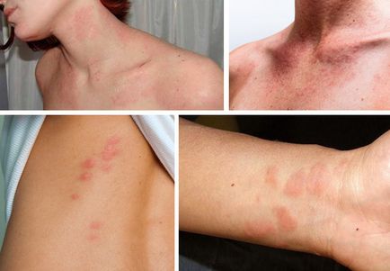 Allergia bőr viszkető, vörös foltok, a kezelés az orvosi drogok, fotó