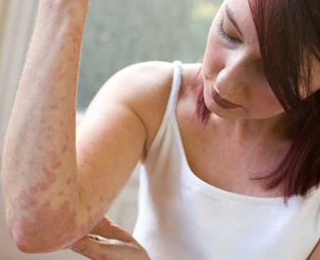 Allergiás bőrtünetek (foltok) és típusai