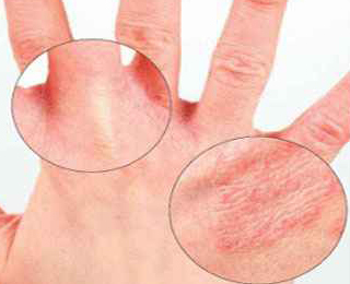 Allergiás bőrtünetek (foltok) és típusai