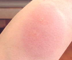 Allergiás a harapás a szúnyog szúnyogok - a nyár csengő és viszketés