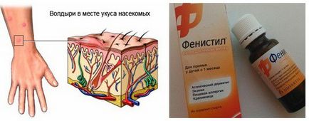 Allergiás a szúnyogcsípés gyermekek fotó, tünetek, kezelés (allergia) Allergiás a szúnyogcsípés gyermekek fotó, tünetek, kezelés