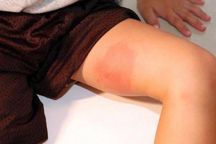 Allergiás a szúnyogcsípés egy gyermek