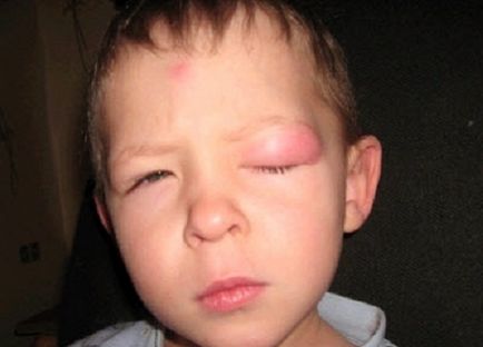 Allergiás a szúnyogcsípés egy gyermek és egy felnőtt, hogyan kell kezelni a duzzanat