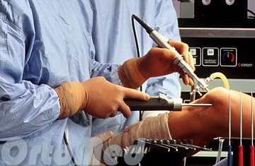 Artroszkópos eltávolítását a meniszkusz a térd, műtétek utáni rehabilitációra, arthroscopia