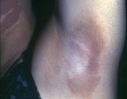 Acanthosis nigricans tünetek, kezelés