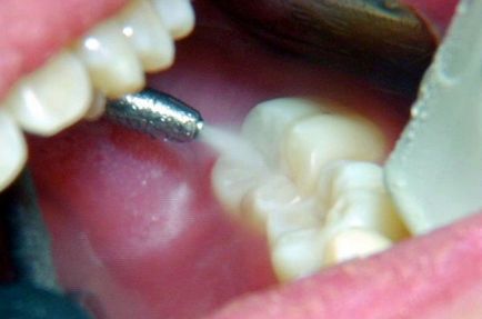 Mit kell tenni, hogy befagyasztja a fogat gyorsan eltelt, eltávolítja az altatás