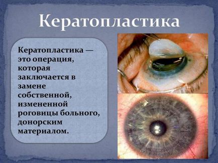 szaruhártya disztrófia szem kezelésére, és hogy ez, hám, endoterialnaya, népi jogorvoslati