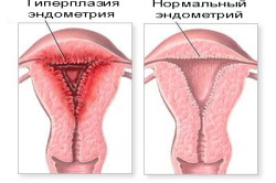 Proliferatív endometrium lépésben típusa
