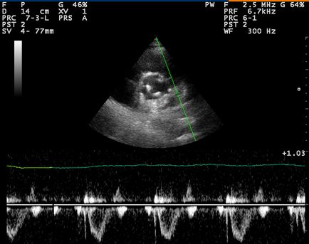 Az echokardiográfia (echo kg) a szív - a fő jelzések, módszerek és az eredmények értelmezése