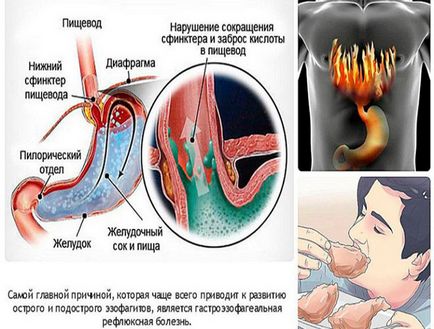 A gastrooesophagealis reflux gyermekeknél (a gyermek a mell, az újszülött)