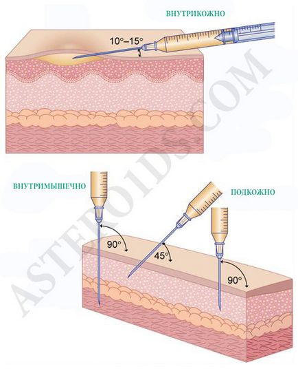 Szteroid injekciók, hogyan kell csinálni injekciót, ha a szúró szteroidok, szteroidok, mint a szúró