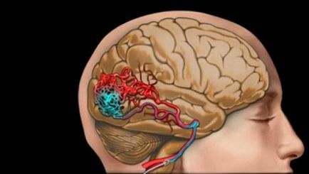 agyi ischaemia, mi ez, tünetek és kezelés hatásának mértékét, mennyi az élő