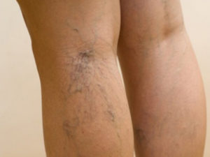 Hogyan és mit kell kezelni a nehéz visszerek a lábát a nők és a férfiak műtét nélkül