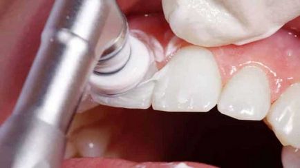 Hogyan kell kezelni a fogszuvasodás különböző szakaszaiban, lépcsők és a kezelési tervet a fogszuvasodás