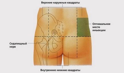 Hogyan készítsünk egy lövés a farba, intramuszkuláris injekciók otthon, a technológia