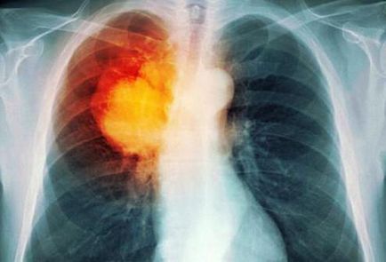 Hogyan lehet ellenőrizni a könnyű módszerek tüdő vizsgálata