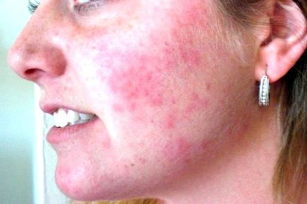 Hogyan működik a bőrallergia, piros foltok és kezelésük