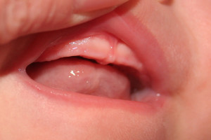 Hogyan lehet csökkenteni a felső fogak csecsemők mennyi ideig tart