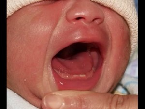 Hogyan lehet csökkenteni a felső fogak csecsemők mennyi ideig tart