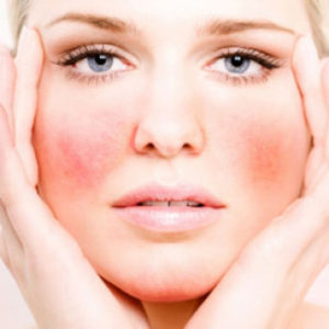 Hogyan lehet eltávolítani a seprűvénák az arcon otthon, rosacea kezelésére