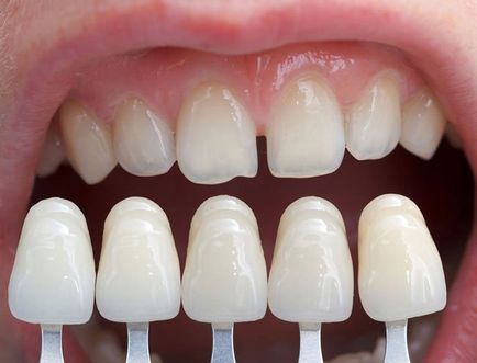 Hogyan kiegyenesedik a fogak otthon otthon egyengető fogak és a gyakori hibák