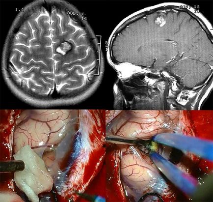agy kavernoma (barlangos anglöma és hemangioma), mi az, következményeinek kezelésére