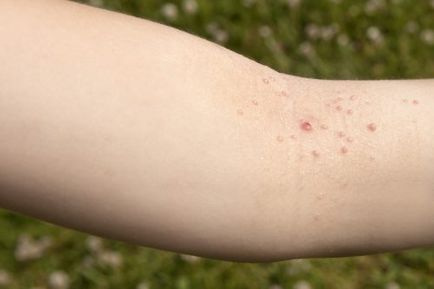 Molluscum contagiosum kezelt gyermekeknél otthon, megszüntetve