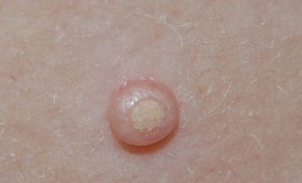 Molluscum contagiosum kezelt gyermekeknél otthon, megszüntetve