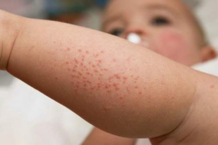 Molluscum contagiosum kezelt gyermekeknél otthon, megszüntetve