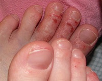Contact dermatitis kezelésére kenőcsöket és népi jogorvoslati