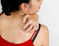 Contact dermatitis kezelésére kenőcsöket és népi jogorvoslati