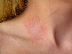 Kontakt dermatitis - kezelés, a tünetek, okok (pin) Kontakt dermatitis - Kezelés, tünetei, okai