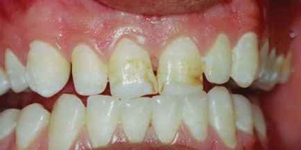 Brown plakk a fogak -, hogyan kell biztonságosan eltávolítani a sötét foltok az otthoni
