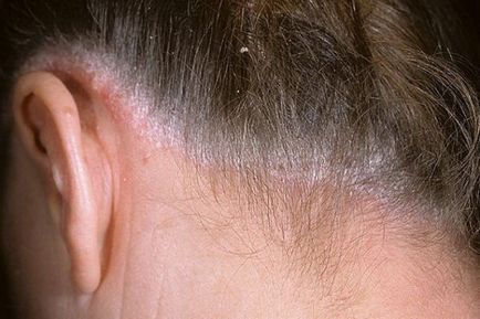 Cork korpásodás a fejét okai és kezelések a kéreg egy felnőtt