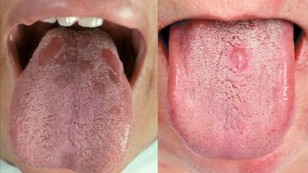 Vér bliszter a nyelv kép és hogyan kell kezelni hólyagok