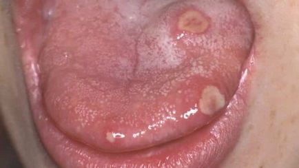 Vér bliszter a nyelv kép és hogyan kell kezelni hólyagok