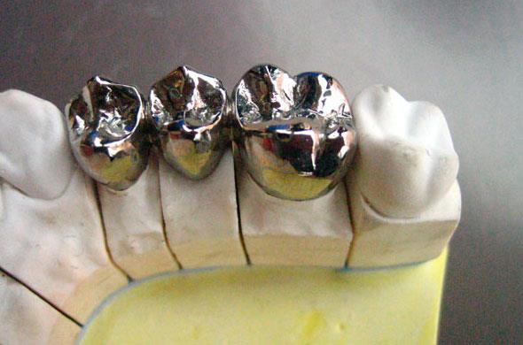 Fém korona fogak előnyei és hátrányai