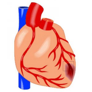 Kisebb szív tünetei kezelés