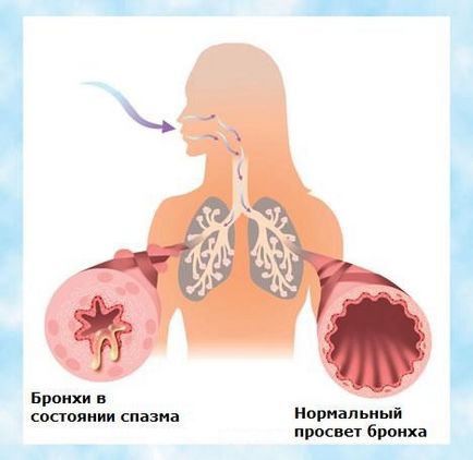 Obstruktív bronchitis kezelésére népi jogorvoslati felnőtteknek és gyerekeknek