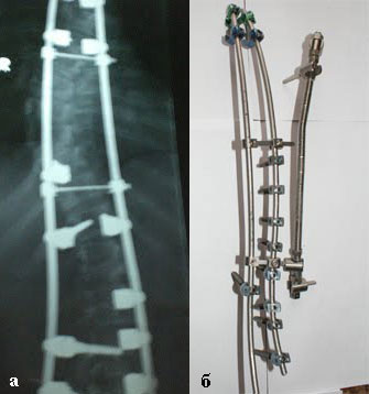 műtét a gerinc gerincferdülés 3, 4 fok típusok, jelzések, főleg sebészeti