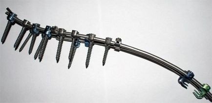 Műtét a gerinc scoliosis 3, 4 fok típusok, jelzések, különösen sebészeti (gerinc) műtét a gerinc gerincferdülés 3, 4 fok típusok, jelzések, főleg sebészeti