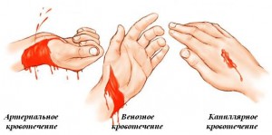 Elsősegély artériás vérzés tételek