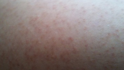 Miért kapok egy kiütés a váll és a hát, bőrbetegségek