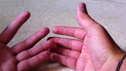 Állandó izzadás kezek okai, kezelése, a szervezet tisztító az emberi egészség