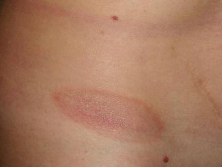 A megjelenése vörös foltok a bőrön okait és allergia kezelésére, viszkető foltok, miért, fotók
